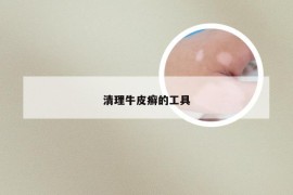 清理牛皮癣的工具