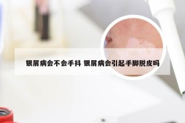 银屑病会不会手抖 银屑病会引起手脚脱皮吗