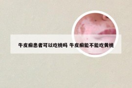 牛皮癣患者可以吃桃吗 牛皮癣能不能吃黄桃