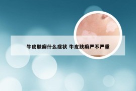 牛皮肤癣什么症状 牛皮肤癣严不严重