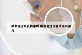 癣会通过母乳传染吗 癣会通过母乳传染吗图片