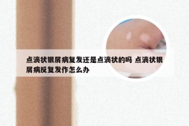 点滴状银屑病复发还是点滴状的吗 点滴状银屑病反复发作怎么办