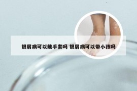 银屑病可以戴手套吗 银屑病可以带小孩吗