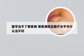 医学治不了银屑病 银屑病现在医疗水平为什么治不好