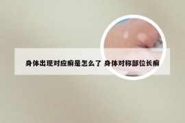 身体出现对应癣是怎么了 身体对称部位长癣