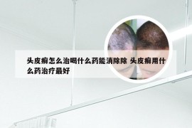 头皮癣怎么治喝什么药能消除除 头皮癣用什么药治疗最好