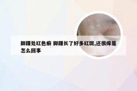 脚踝处红色癣 脚踝长了好多红斑,还很痒是怎么回事