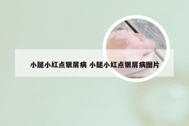 小腿小红点银屑病 小腿小红点银屑病图片