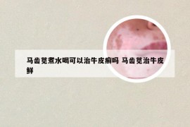 马齿苋煮水喝可以治牛皮癣吗 马齿苋治牛皮鲜