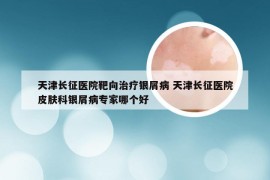 天津长征医院靶向治疗银屑病 天津长征医院皮肤科银屑病专家哪个好