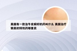 美国有一款治牛皮癣好的药叫什么 美国治疗银屑的特效药哪里卖