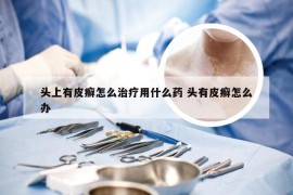 头上有皮癣怎么治疗用什么药 头有皮癣怎么办