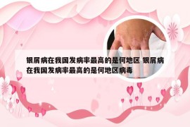 银屑病在我国发病率最高的是何地区 银屑病在我国发病率最高的是何地区病毒