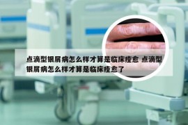 点滴型银屑病怎么样才算是临床痊愈 点滴型银屑病怎么样才算是临床痊愈了