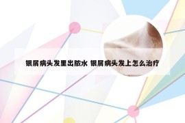 银屑病头发里出脓水 银屑病头发上怎么治疗