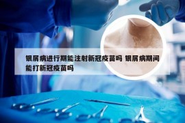银屑病进行期能注射新冠疫苗吗 银屑病期间能打新冠疫苗吗