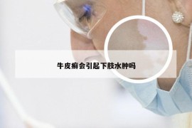牛皮癣会引起下肢水肿吗