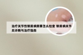 治疗关节性银屑病需要怎么检查 银屑病关节炎诊断与治疗指南