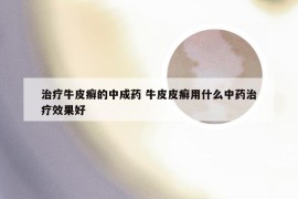 治疗牛皮癣的中成药 牛皮皮癣用什么中药治疗效果好
