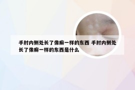 手肘内侧处长了像癣一样的东西 手肘内侧处长了像癣一样的东西是什么