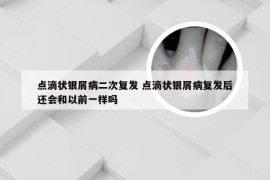 点滴状银屑病二次复发 点滴状银屑病复发后还会和以前一样吗
