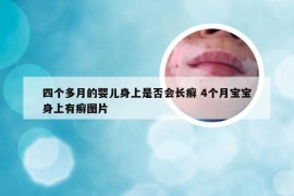 四个多月的婴儿身上是否会长癣 4个月宝宝身上有癣图片
