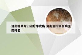 济南哪家专门治疗牛皮癣 济南治疗银屑病医院排名