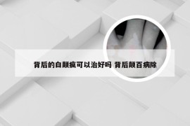 背后的白颠疯可以治好吗 背后颠百病除