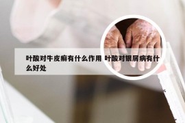 叶酸对牛皮癣有什么作用 叶酸对银屑病有什么好处