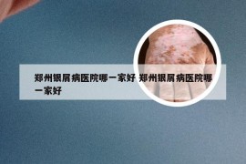 郑州银屑病医院哪一家好 郑州银屑病医院哪一家好