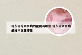 山东治疗银屑病的医院有哪些 山东治银屑病最好中医在哪里