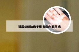 银屑病精油佛手柑 精油与银屑病