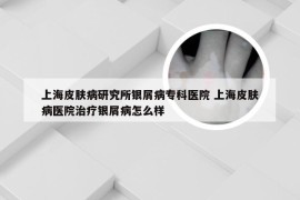 上海皮肤病研究所银屑病专科医院 上海皮肤病医院治疗银屑病怎么样
