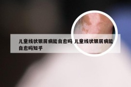 儿童线状银屑病能自愈吗 儿童线状银屑病能自愈吗知乎