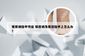 银屑病指甲传染 银屑病发展到指甲上怎么办?