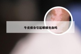 牛皮癣会引起眼睛充血吗