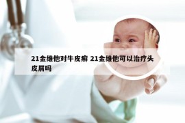 21金维他对牛皮癣 21金维他可以治疗头皮屑吗