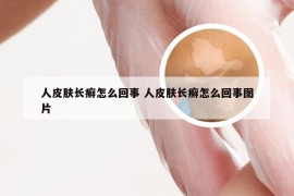 人皮肤长癣怎么回事 人皮肤长癣怎么回事图片