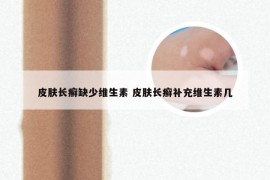 皮肤长癣缺少维生素 皮肤长癣补充维生素几