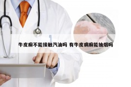 牛皮癣不能接触汽油吗 有牛皮病癣能抽烟吗