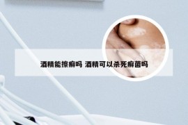 酒精能擦癣吗 酒精可以杀死癣菌吗
