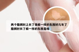 两个胳膊肘上长了像癣一样的东西好几年了 胳膊肘长了癣一样的东西是啥