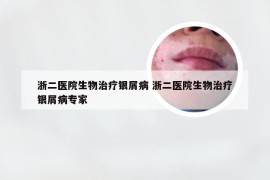 浙二医院生物治疗银屑病 浙二医院生物治疗银屑病专家