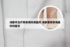 成都市治疗银屑病权威医院 成都看银屑病最好的医生
