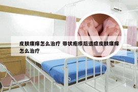 皮肤瘙痒怎么治疗 带状疱疹后遗症皮肤瘙痒怎么治疗