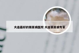 大连最好的银屑病医院 大连银屑病专家