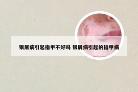 银屑病引起指甲不好吗 银屑病引起的指甲病