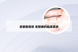 皮肤藓症状 皮肤癣的临床症状