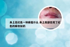 身上出红色一块癣是什么 身上局部出现了红色的癣也似的
