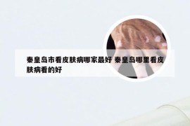 秦皇岛市看皮肤病哪家最好 秦皇岛哪里看皮肤病看的好